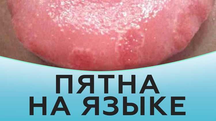 Диагностика белых образований на слизистой