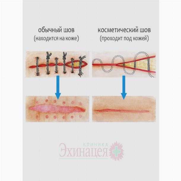 Когда обращаться к врачу после удаления швов?