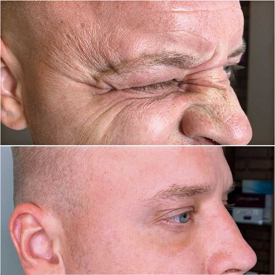 Ботокс